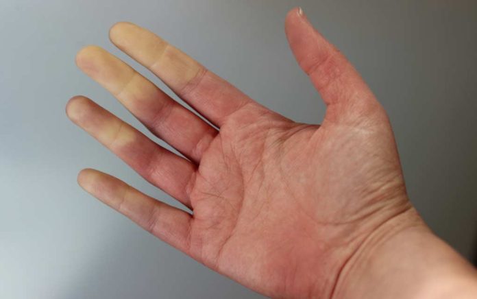 Red-White-and-Blue-Extremities-Could-You-Have-Raynaud-s Red, White and Blue Extremities: Could You Have Raynaud’s?