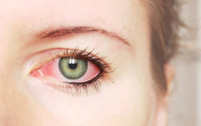 7-Causes-of-Red-Eyes-Besides-Pink-Eye 7 Causes of Red Eyes Besides Pink Eye